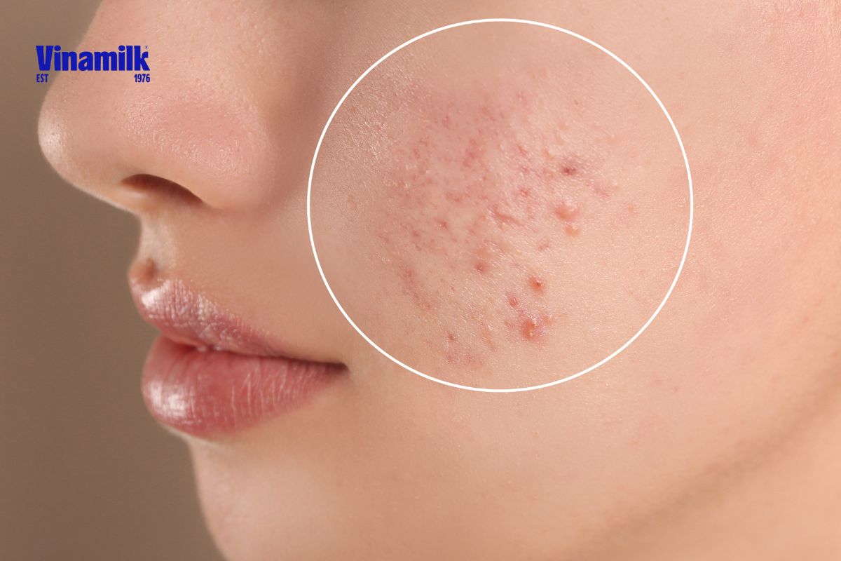 nguyên nhân gây mụn